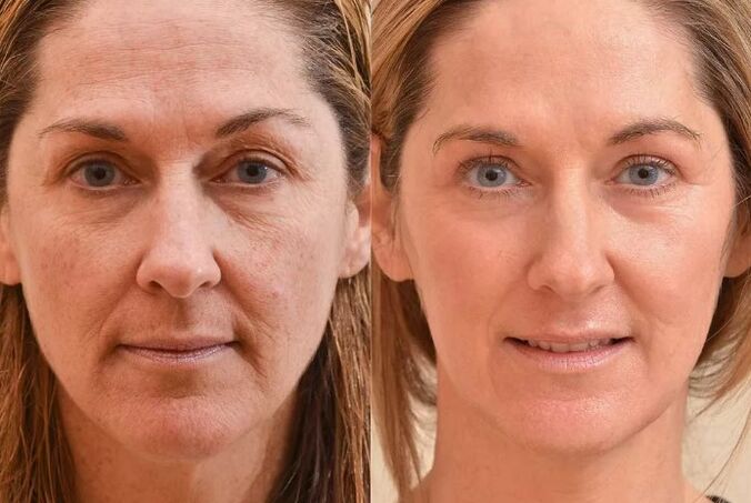 Face renovation before and after