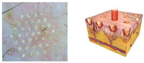 Partial laser affects the point of skin
