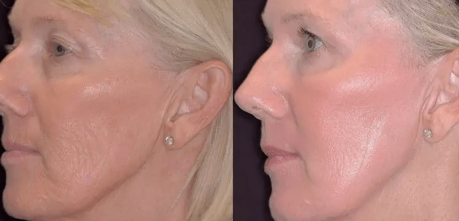Fotermoliza laser before and after