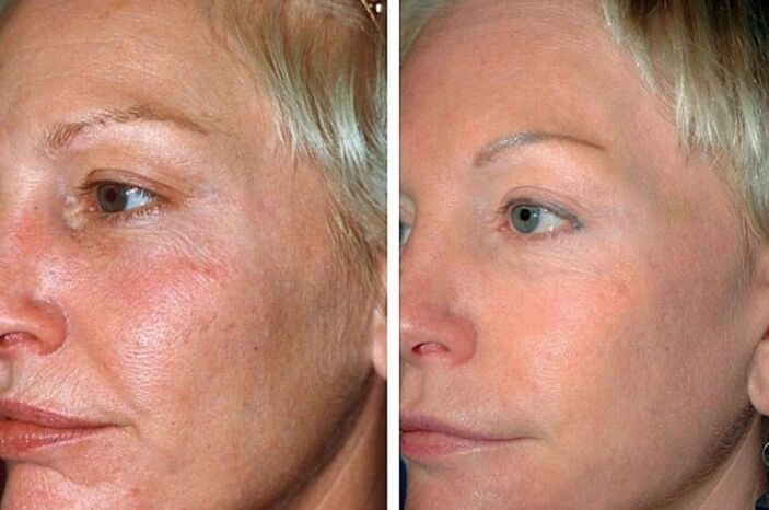 Before and after the renewal procedure