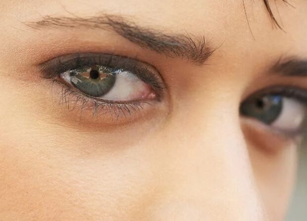 Dark circles under the eyes