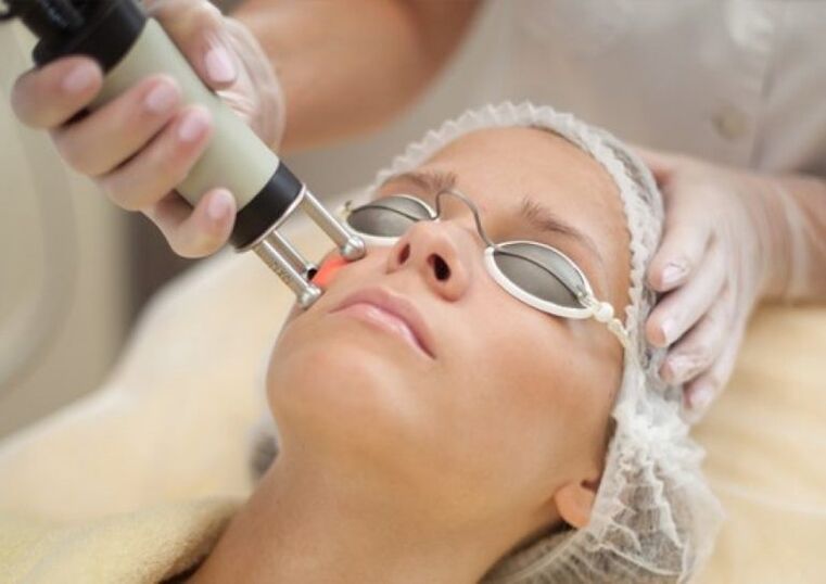 Laser renewal procedure on the ground