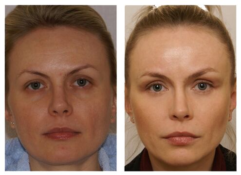 Course of meso cocktail injections