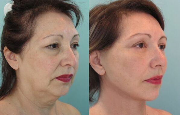 The result of threading