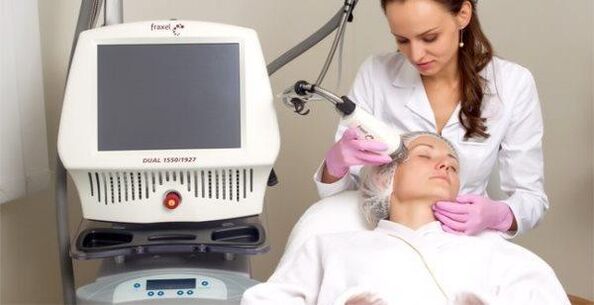 Fractional laser skin resurfacing