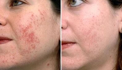 Photos before and after fractional skin rejuvenation