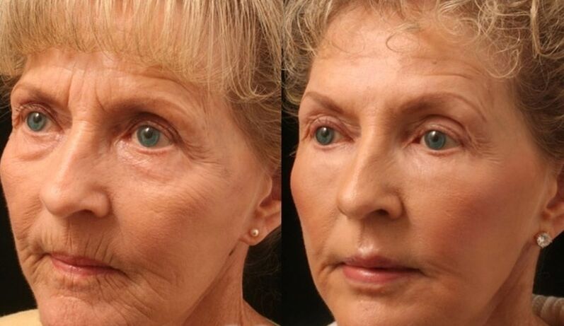 photo before and after partial laser rejuvenation