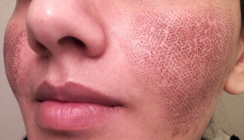 skin after partial laser rejuvenation