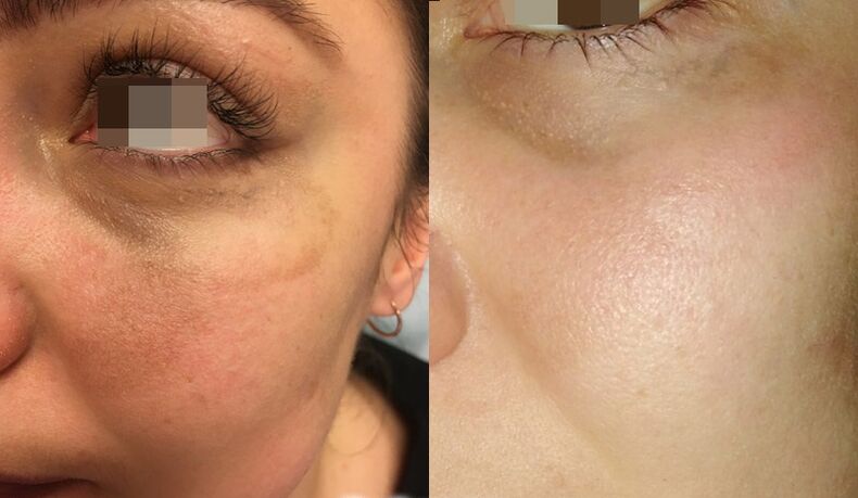 skin before and after partial laser rejuvenation