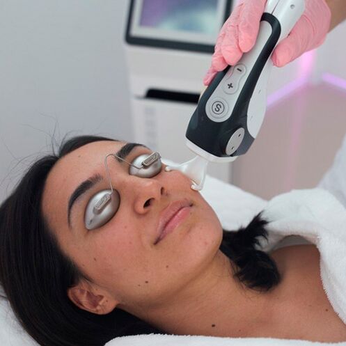 Facial skin treatment with partial laser
